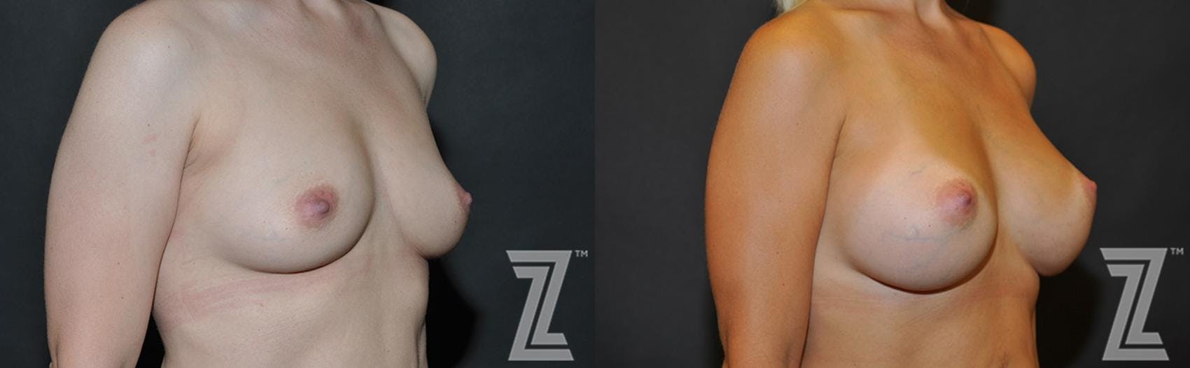 Breast Augmentation Before & After Gallery - Patient 132790600 - Image 4
