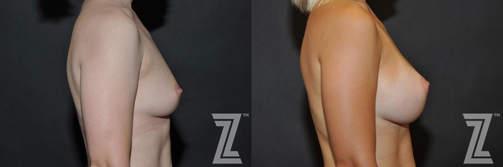 Breast Augmentation Before & After Gallery - Patient 132790600 - Image 5