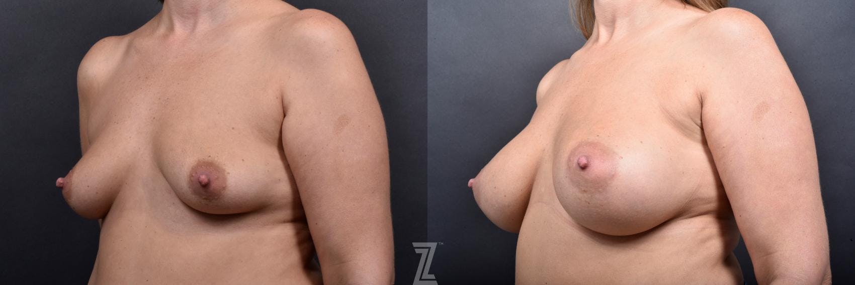 Breast Augmentation Before & After Gallery - Patient 132790601 - Image 2