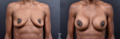 Breast Augmentation Before & After Gallery - Patient 132790602 - Image 1