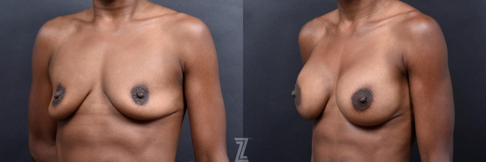 Breast Augmentation Before & After Gallery - Patient 132790602 - Image 2