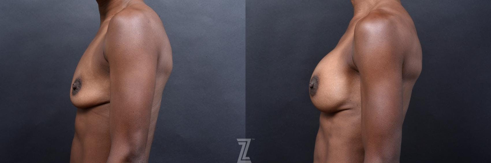 Breast Augmentation Before & After Gallery - Patient 132790602 - Image 3