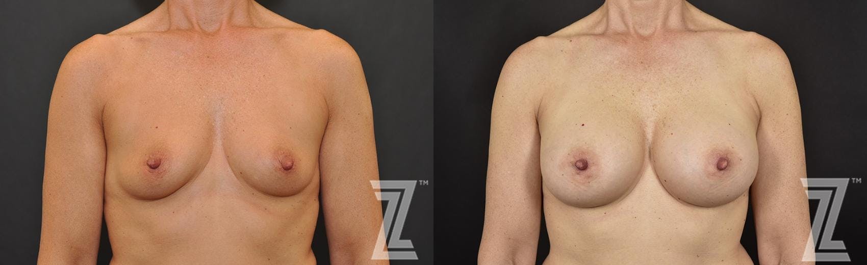 Breast Augmentation Before & After Gallery - Patient 132790606 - Image 1