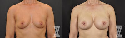 Austin 53 Year Old 3 year Post-OP Breast Augmentation Before & After in Austin, TX - The Piazza Center - Lateral View - The Piazza Center