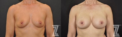 Breast Augmentation Before & After Gallery - Patient 132790606 - Image 1