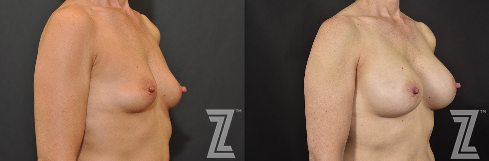 Breast Augmentation Before & After Gallery - Patient 132790606 - Image 4