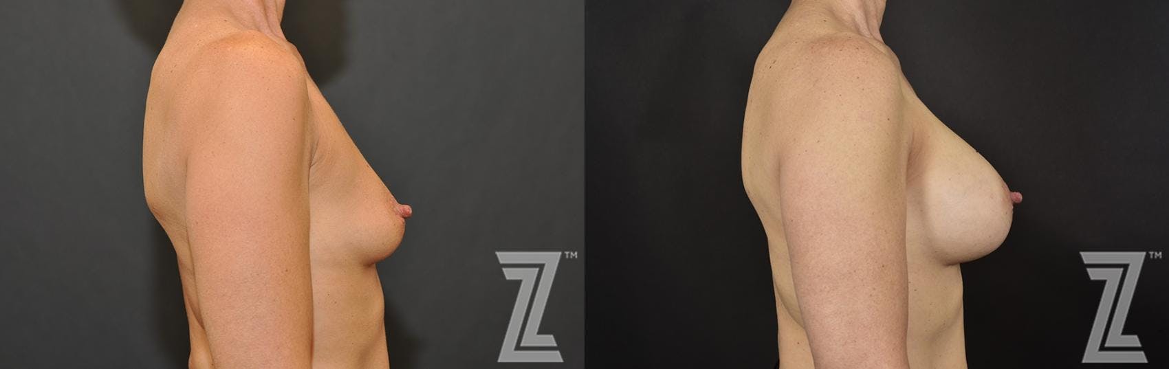 Breast Augmentation Before & After Gallery - Patient 132790606 - Image 5
