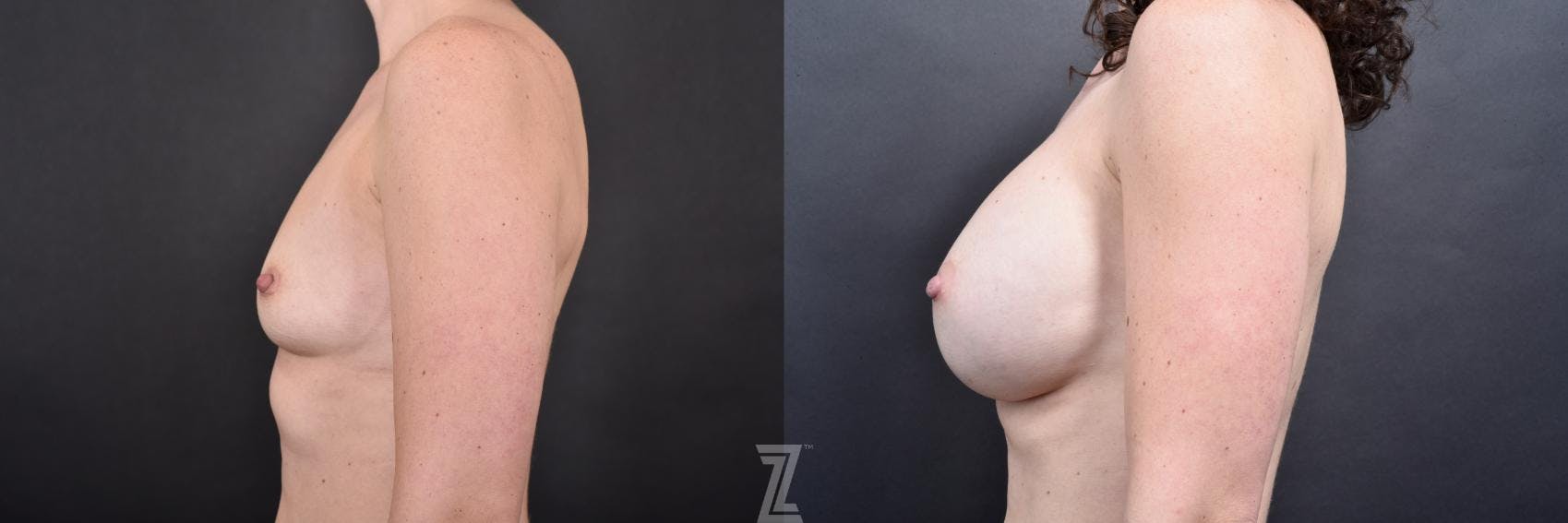 Breast Augmentation Before & After Gallery - Patient 132790607 - Image 3