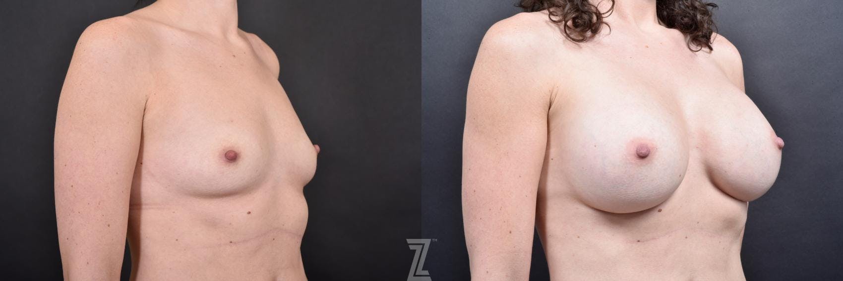 Breast Augmentation Before & After Gallery - Patient 132790607 - Image 4