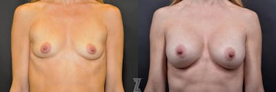 Austin Frontal View Before and After 4 year post op of 41 year old woman with Silicone Implants with Cohesive Silicone Gel - Dr. Rocco Piazza - The Piazza Center