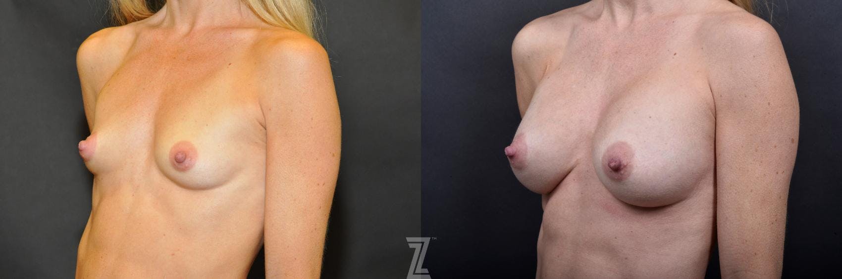 Breast Augmentation Before & After Gallery - Patient 132790608 - Image 2