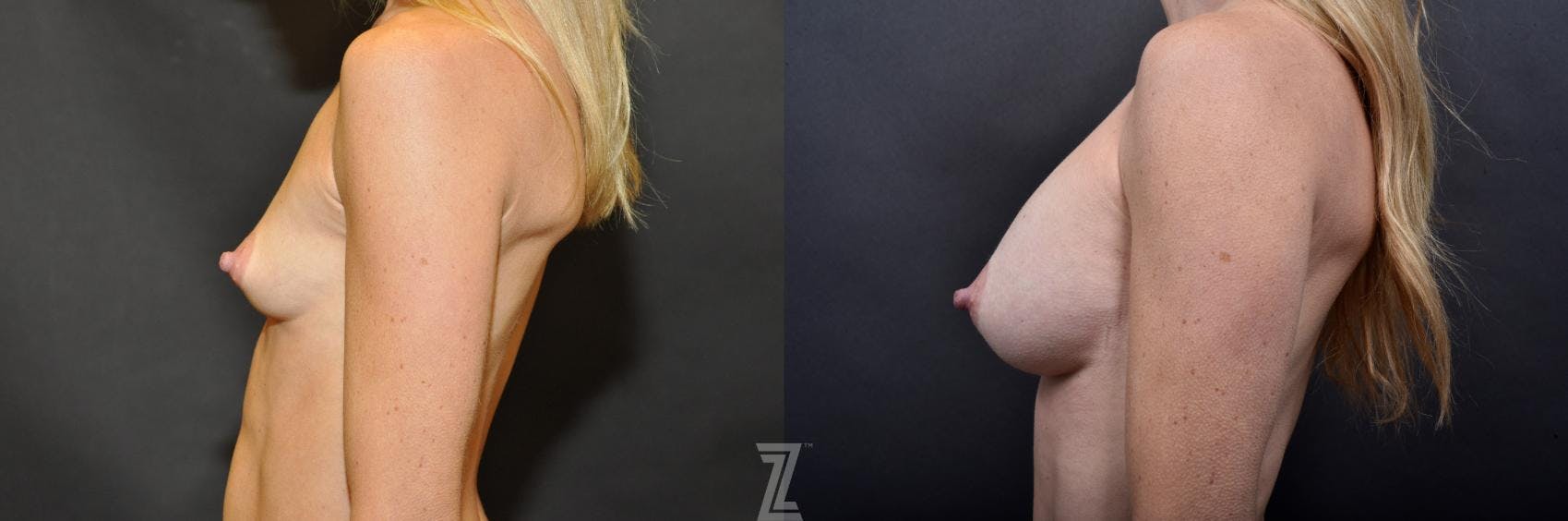 Breast Augmentation Before & After Gallery - Patient 132790608 - Image 3