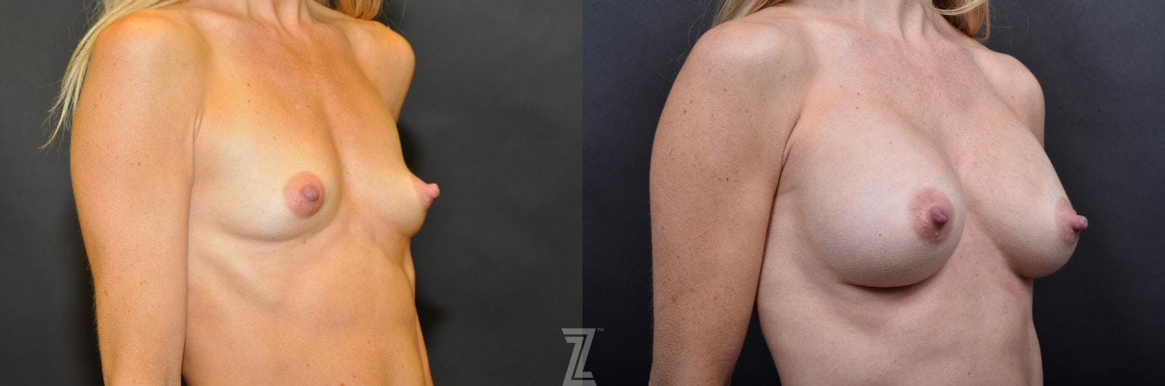 Breast Augmentation Before & After Gallery - Patient 132790608 - Image 4