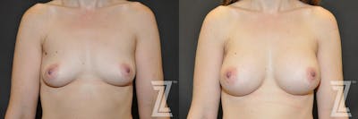Austin Bilateral view before & after of 34 year old woman with Silicone Implants with Cohesive Silicone Gel - The Piazza Center - The Piazza Center