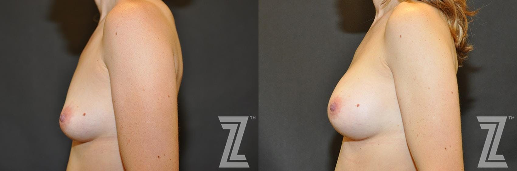 Breast Augmentation Before & After Gallery - Patient 132790609 - Image 3