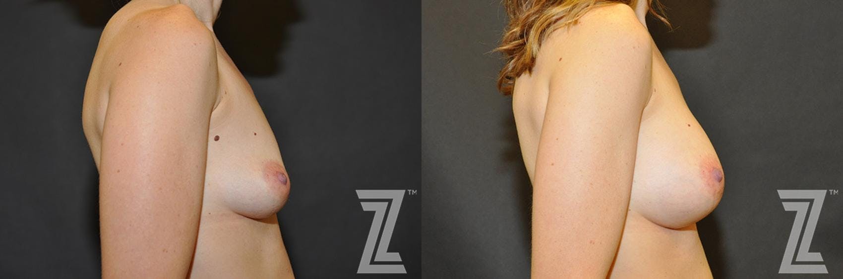Breast Augmentation Before & After Gallery - Patient 132790609 - Image 5