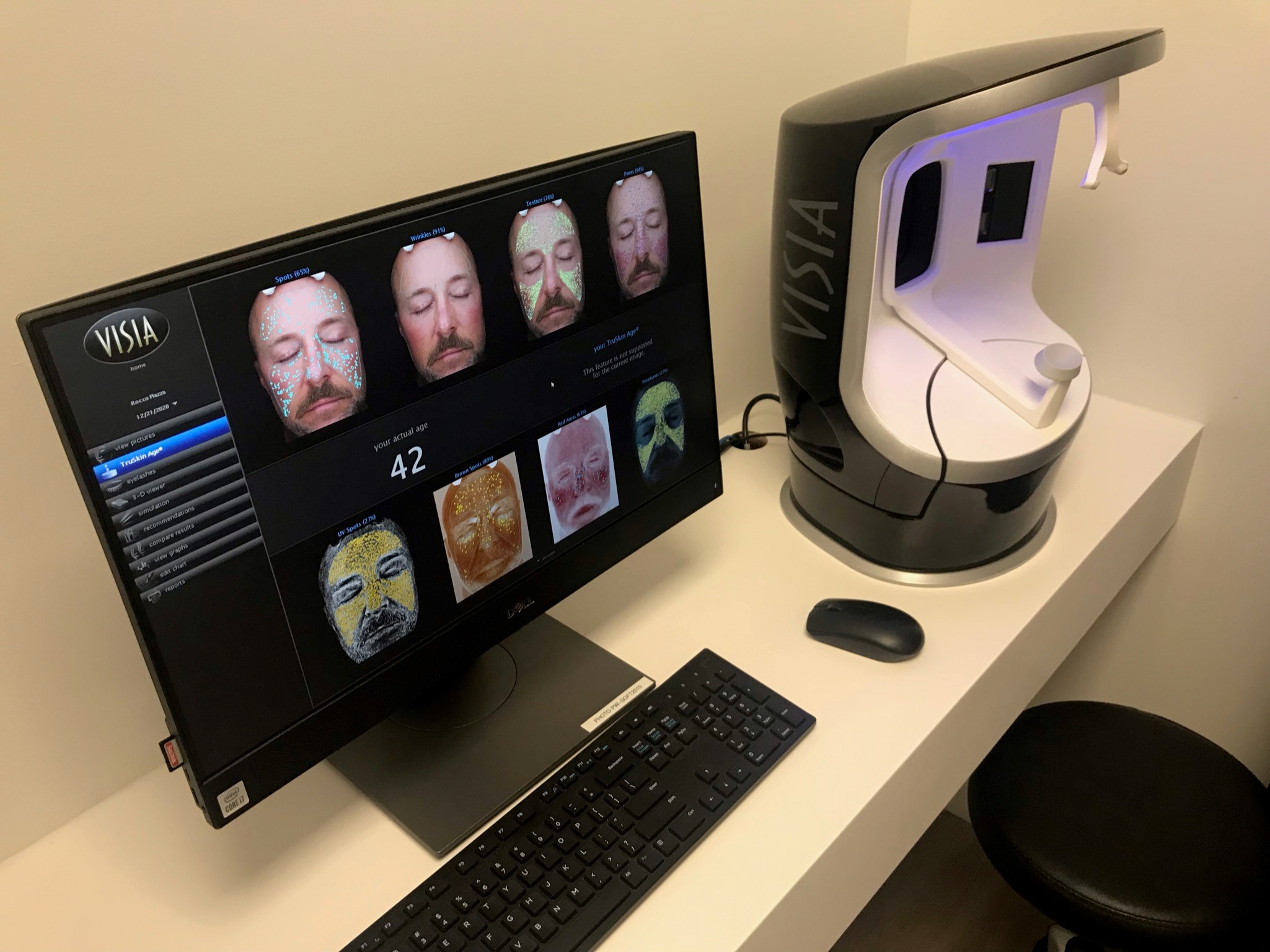 VISIA Skin Analysis system displaying Dr. Piazza's skin assessment