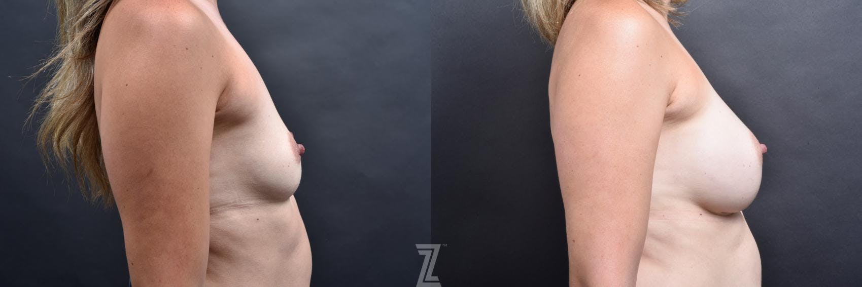 Breast Augmentation Before & After Gallery - Patient 132790610 - Image 5