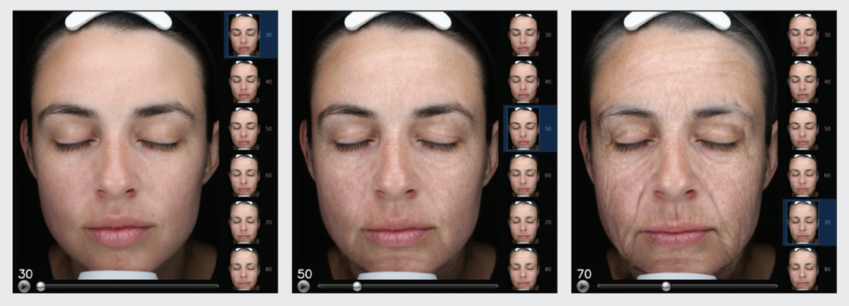 Woman's face shown during Visia aging simulation