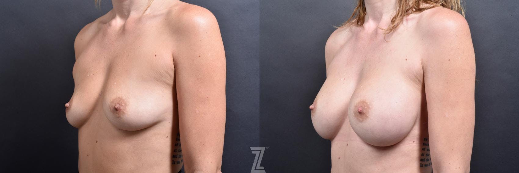 Breast Augmentation Before & After Gallery - Patient 132790616 - Image 2