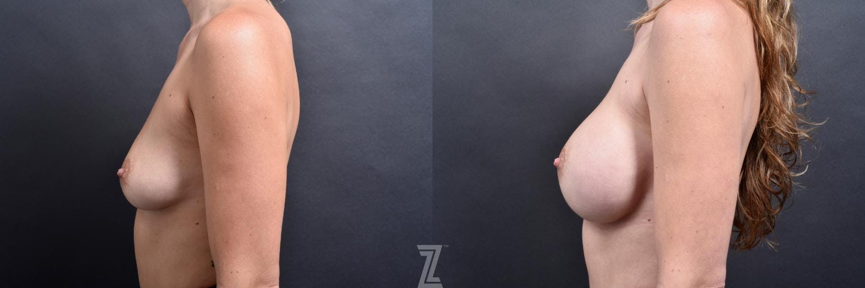 Breast Augmentation Before & After Gallery - Patient 132790616 - Image 3
