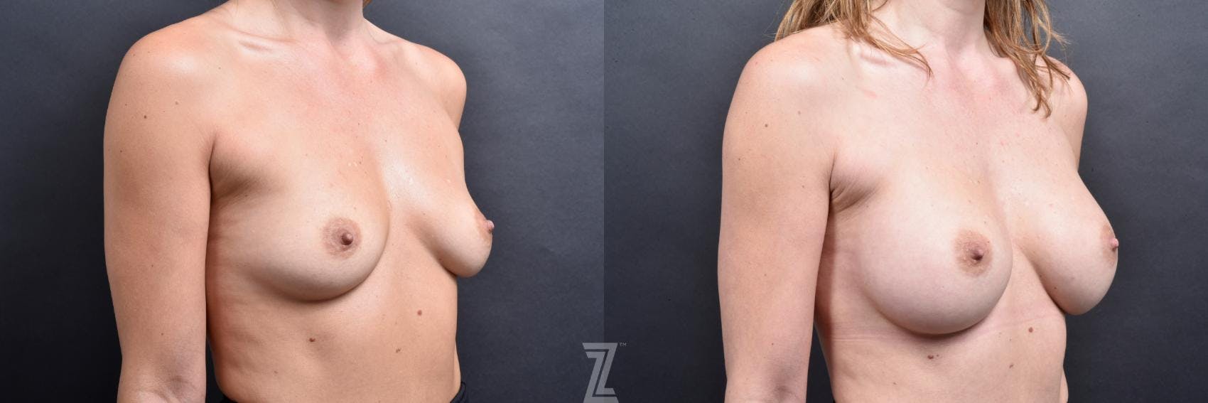 Breast Augmentation Before & After Gallery - Patient 132790616 - Image 4