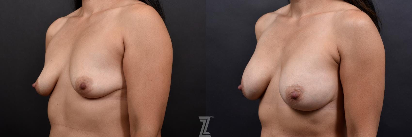 Breast Augmentation Before & After Gallery - Patient 132790624 - Image 2