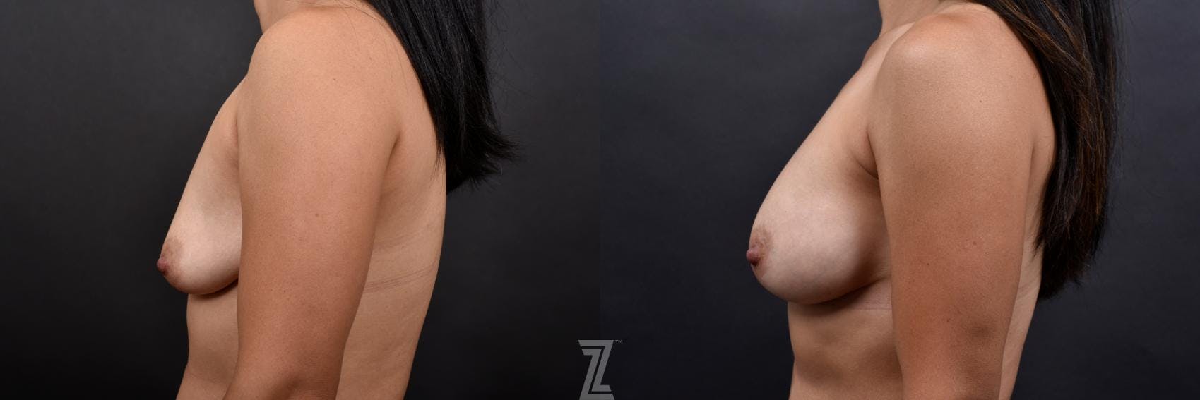 Breast Augmentation Before & After Gallery - Patient 132790624 - Image 3