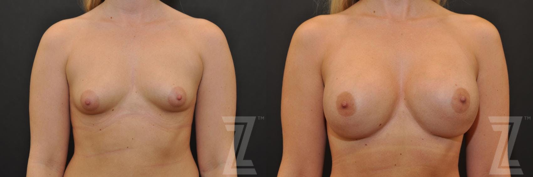 Breast Augmentation Before & After Gallery - Patient 132790634 - Image 1