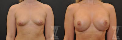 Austin Bilateral view before & after images of 24 year old woman with Silicone Implants with Cohesive Silicone Gel - Dr. Rocco Piazza - The Piazza Center