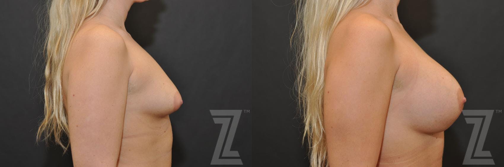 Breast Augmentation Before & After Gallery - Patient 132790634 - Image 5