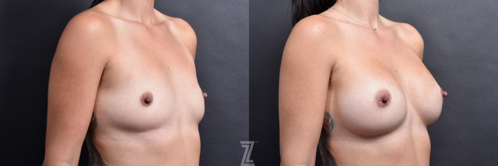 Breast Augmentation Before & After Gallery - Patient 132790638 - Image 4