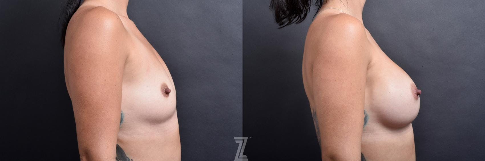 Breast Augmentation Before & After Gallery - Patient 132790638 - Image 5