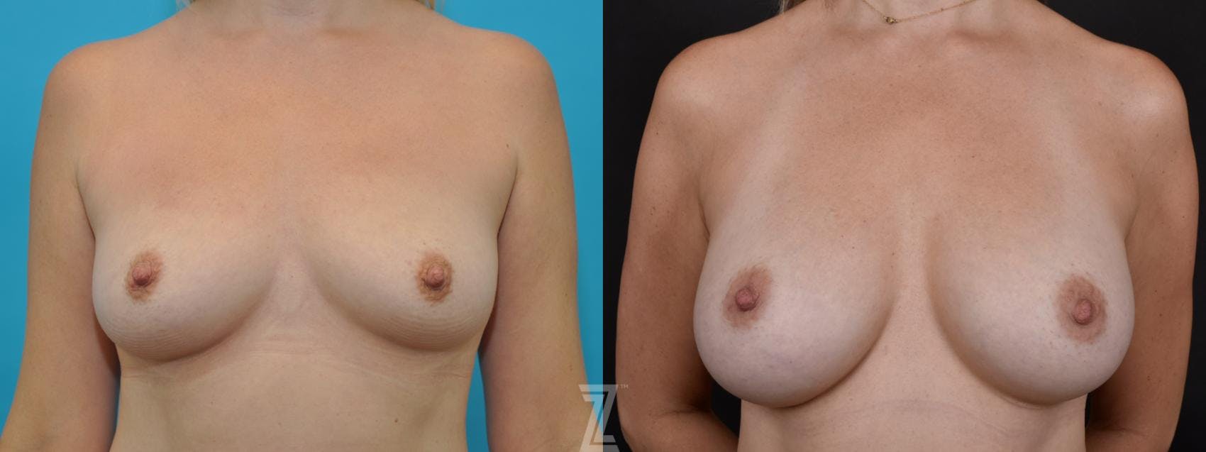 Breast Augmentation Before & After Gallery - Patient 132790646 - Image 1