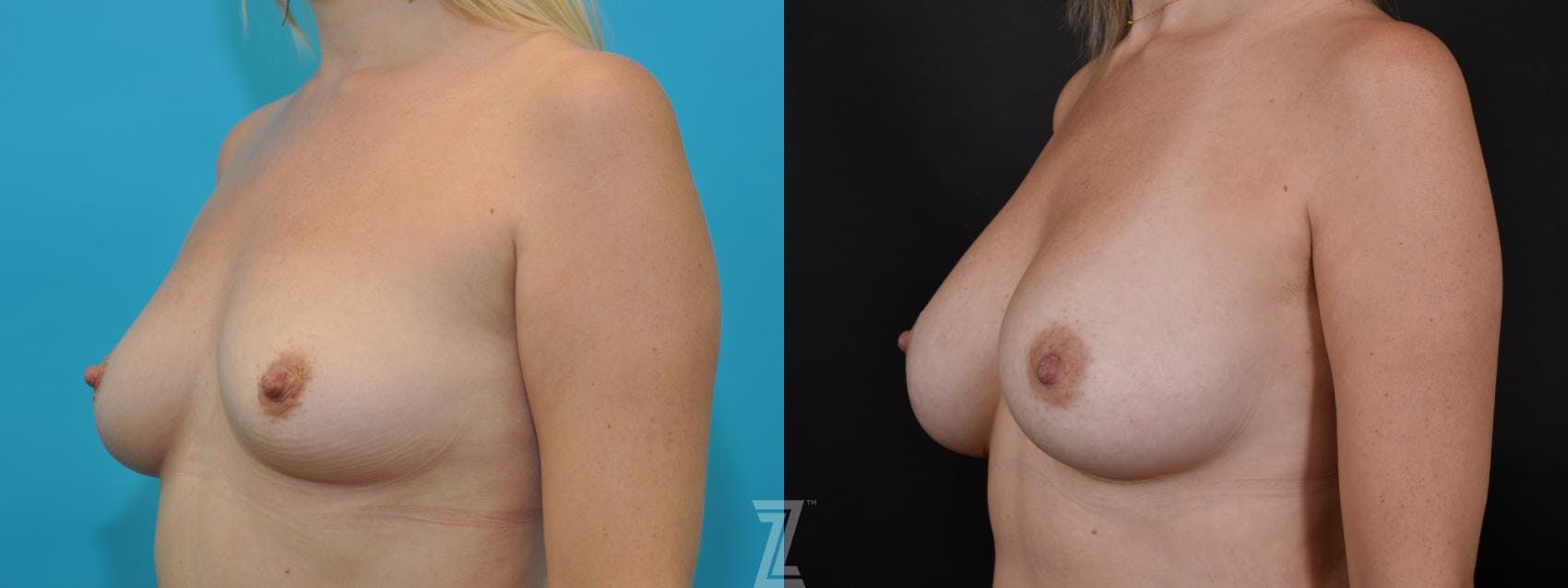 Breast Augmentation Before & After Gallery - Patient 132790646 - Image 2