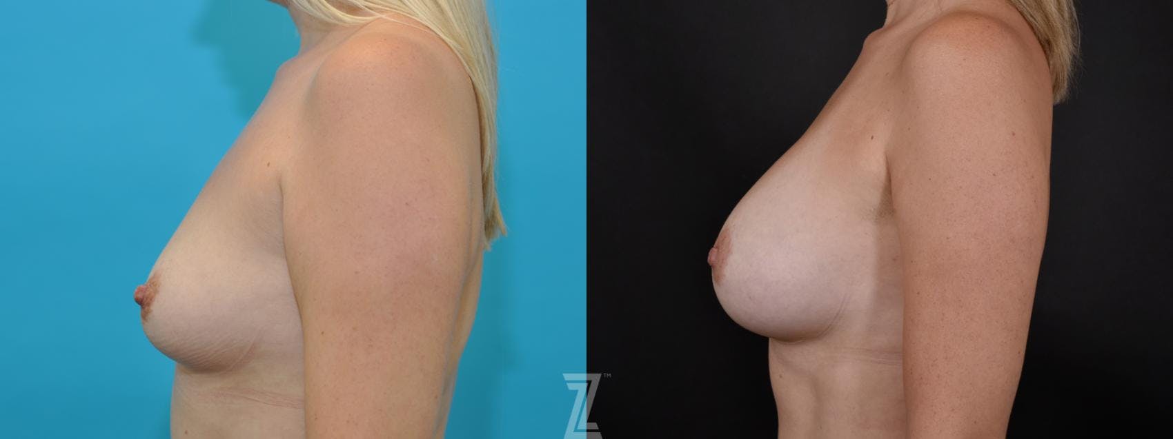 Breast Augmentation Before & After Gallery - Patient 132790646 - Image 3