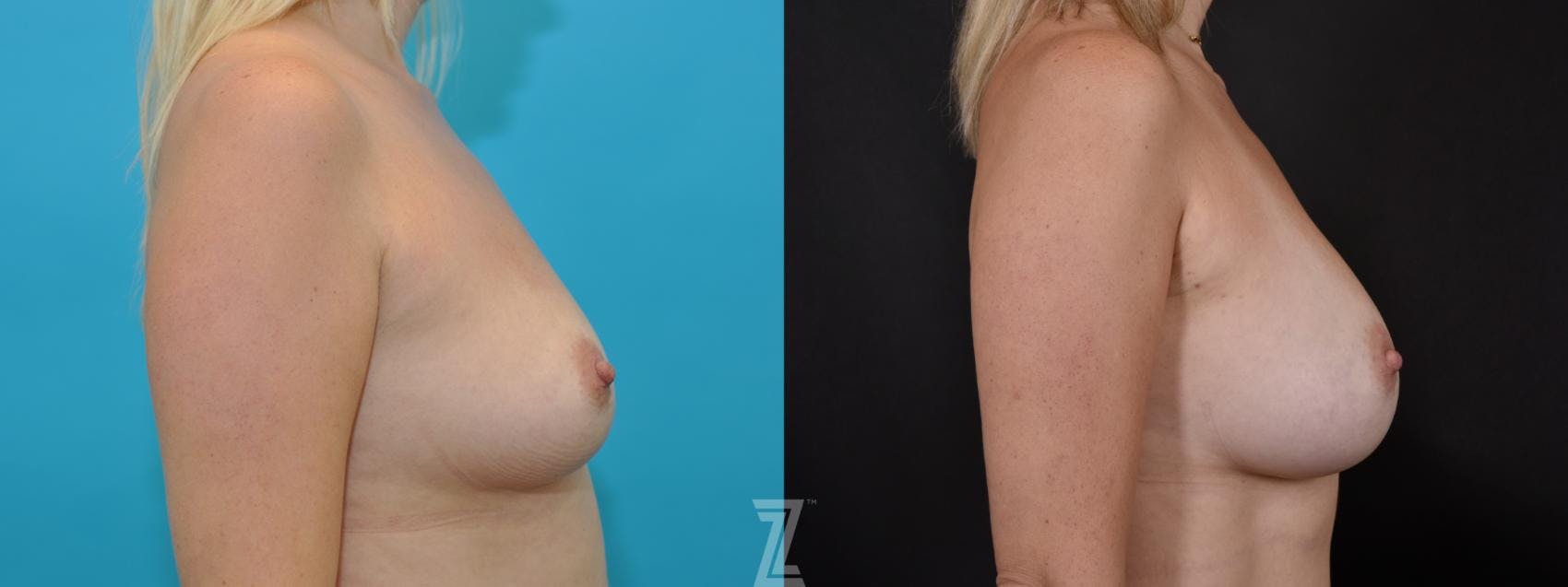 Breast Augmentation Before & After Gallery - Patient 132790646 - Image 5