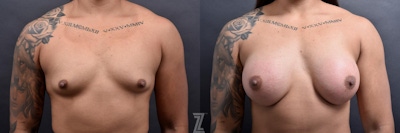 Breast Augmentation Before & After Gallery - Patient 132790650 - Image 1