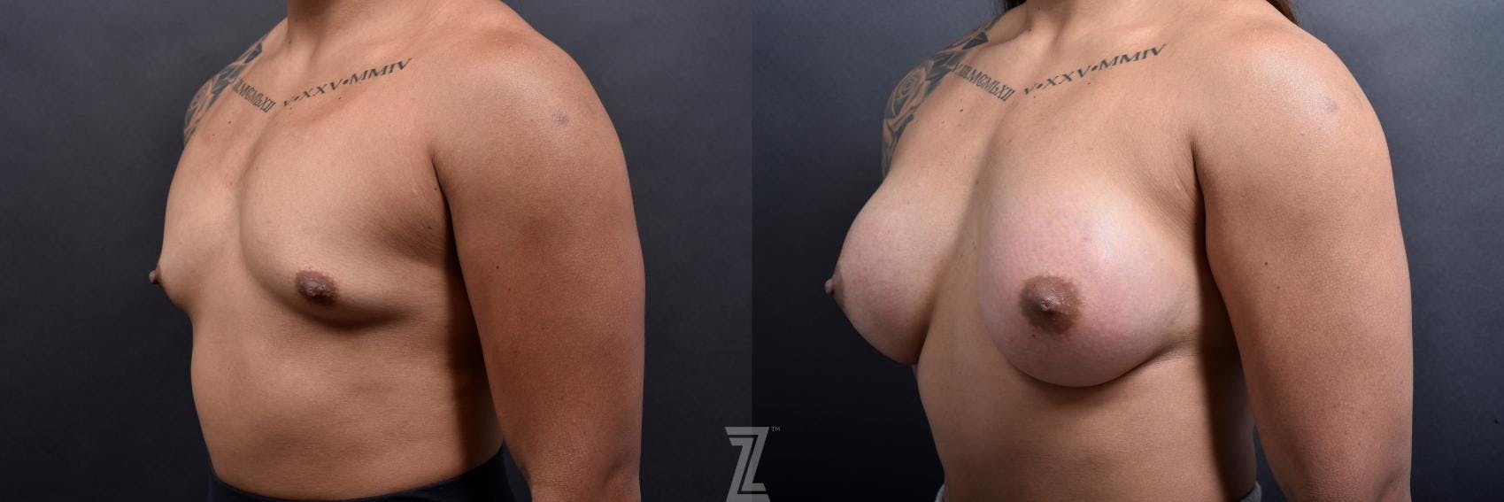 Breast Augmentation Before & After Gallery - Patient 132790650 - Image 2