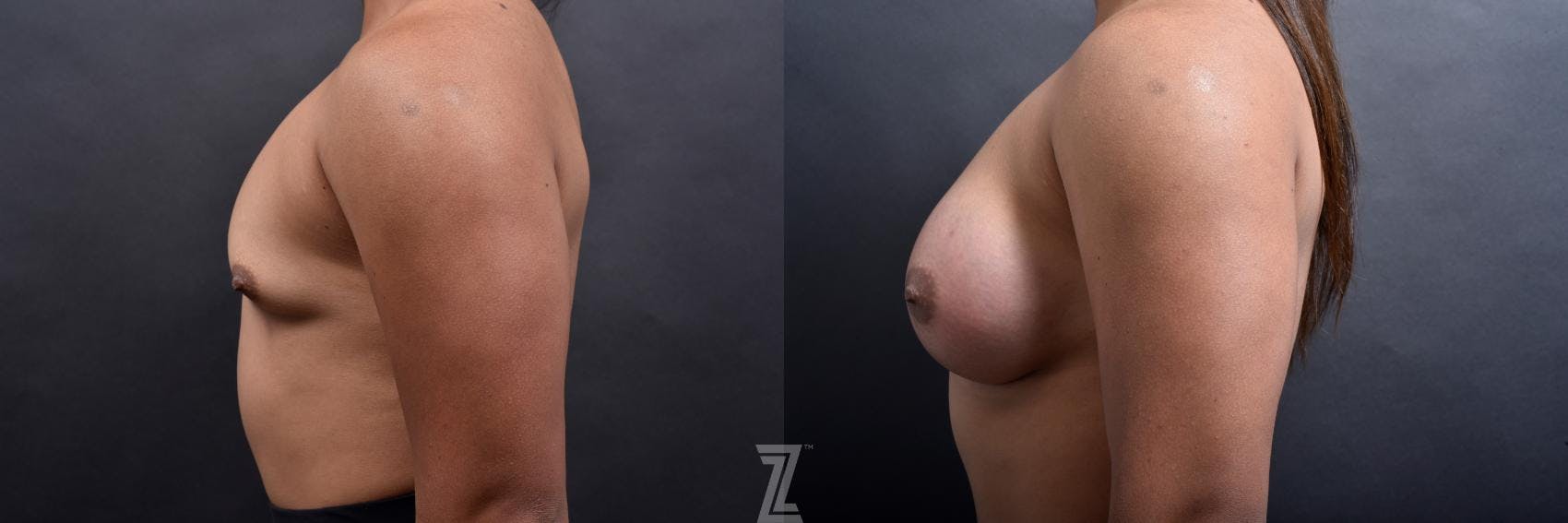 Breast Augmentation Before & After Gallery - Patient 132790650 - Image 3