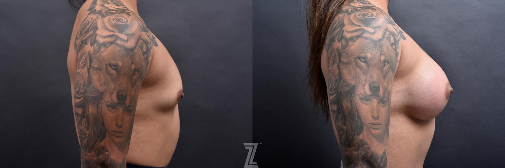 Breast Augmentation Before & After Gallery - Patient 132790650 - Image 5