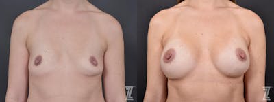 Austin Bilateral view of before & after 2 year post op 36 year old woman with breast augmentation - The Piazza Center
