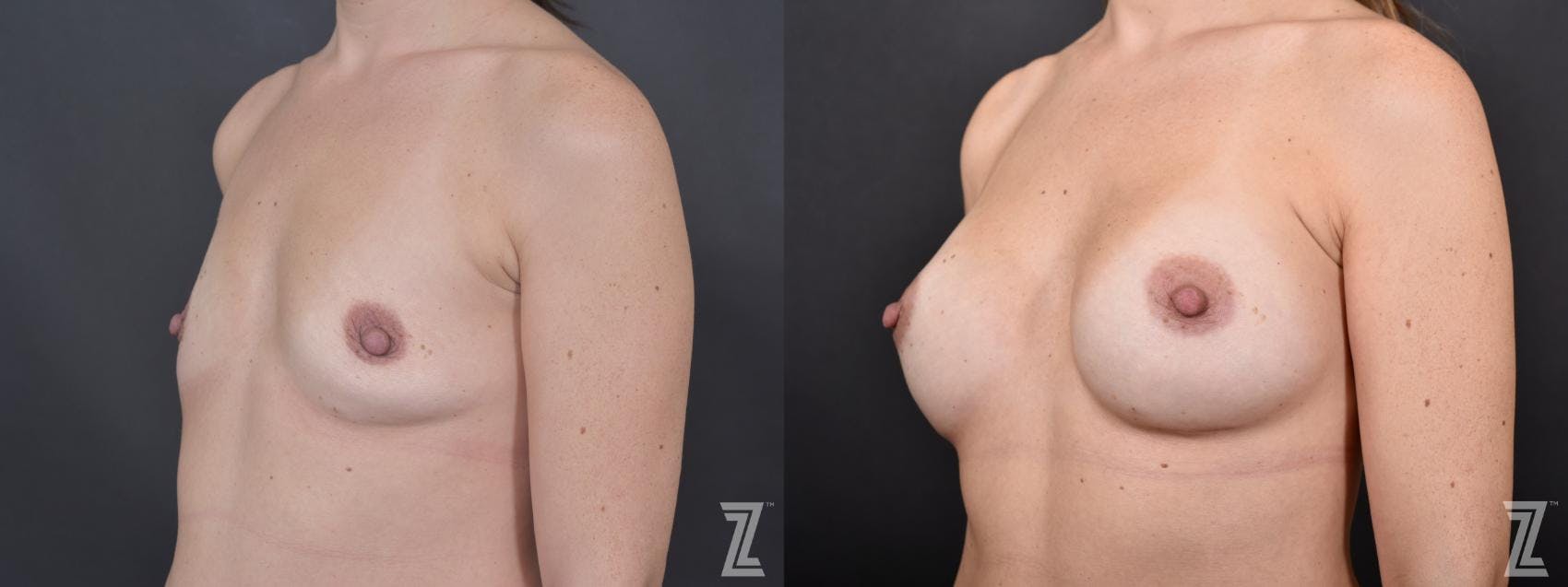 Breast Augmentation Before & After Gallery - Patient 132790655 - Image 2