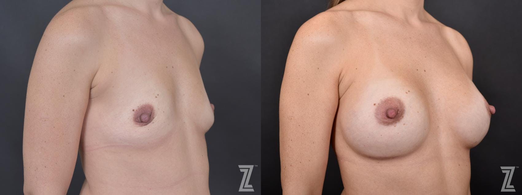 Breast Augmentation Before & After Gallery - Patient 132790655 - Image 4