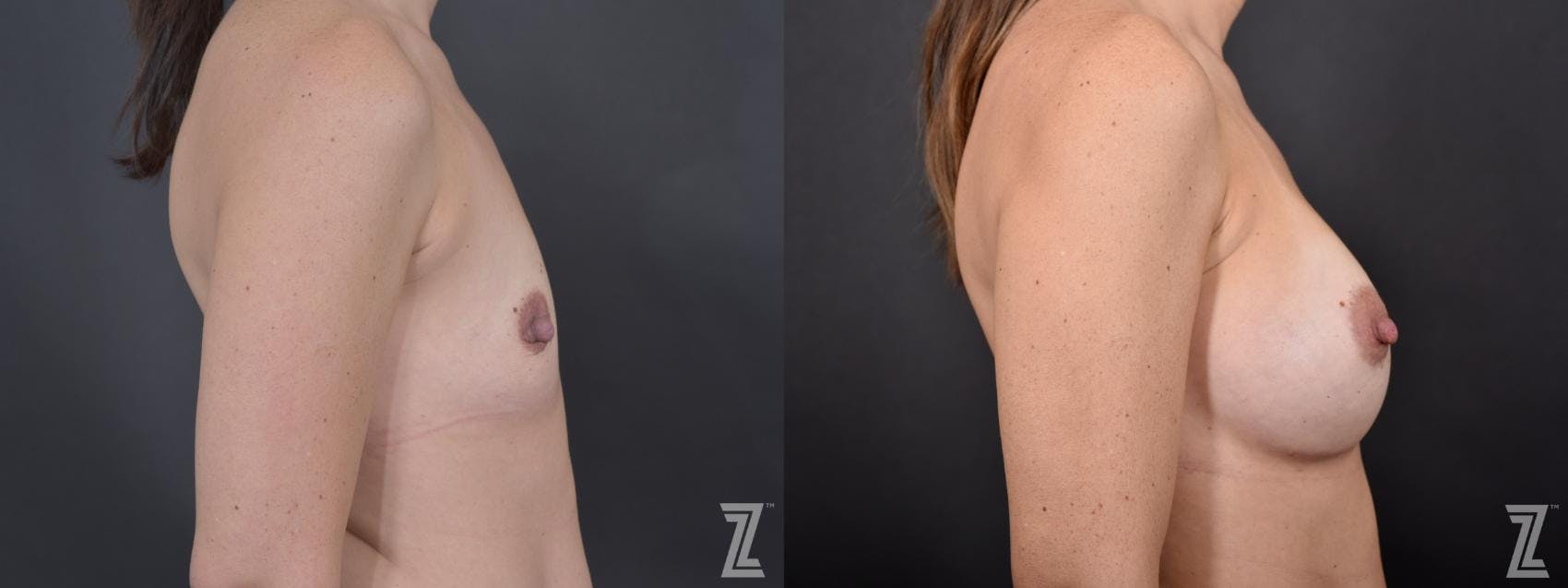 Breast Augmentation Before & After Gallery - Patient 132790655 - Image 5