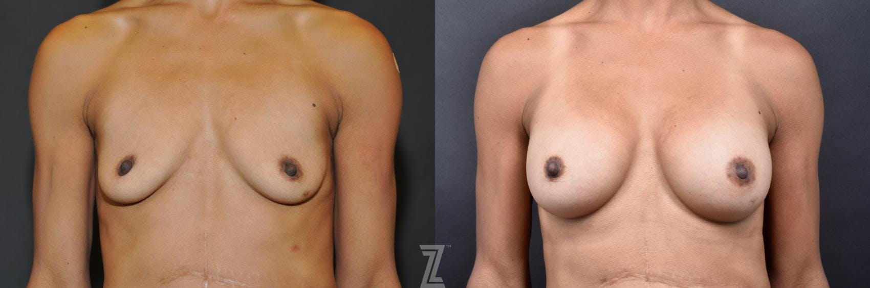 Breast Augmentation Before & After Gallery - Patient 132790659 - Image 1