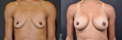 Austin Bilateral view before & after images of 35-year-old mother with breat augmentation - Dr. Rocco Piazza - The Piazza Center