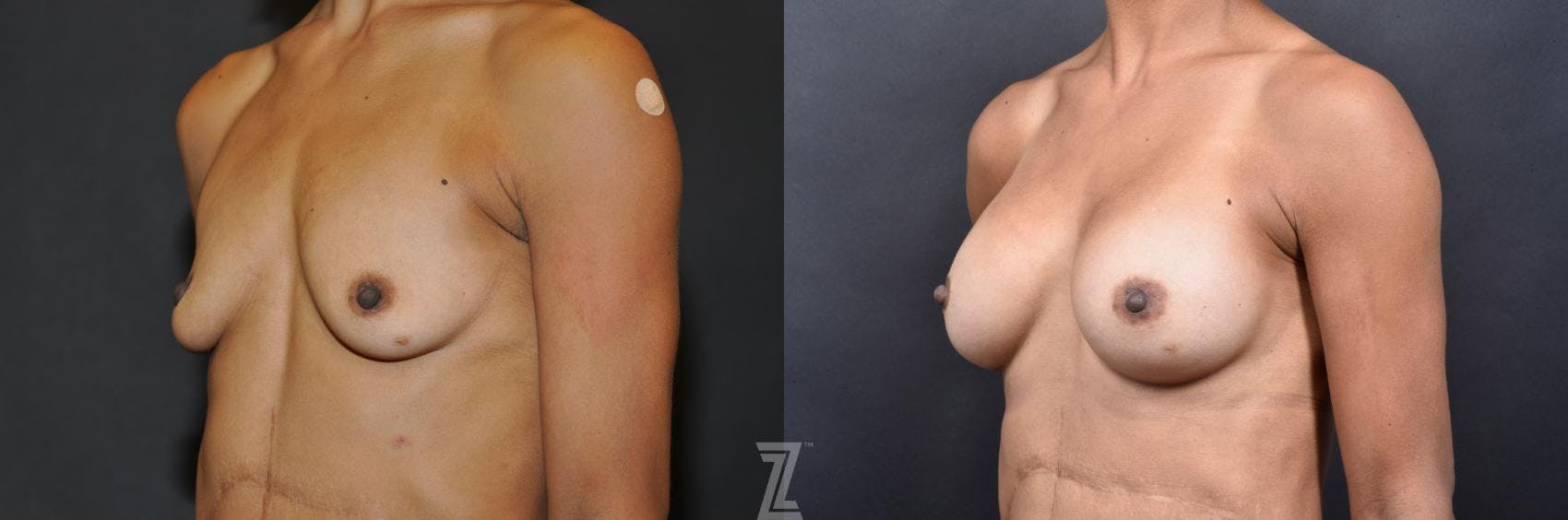 Breast Augmentation Before & After Gallery - Patient 132790659 - Image 2