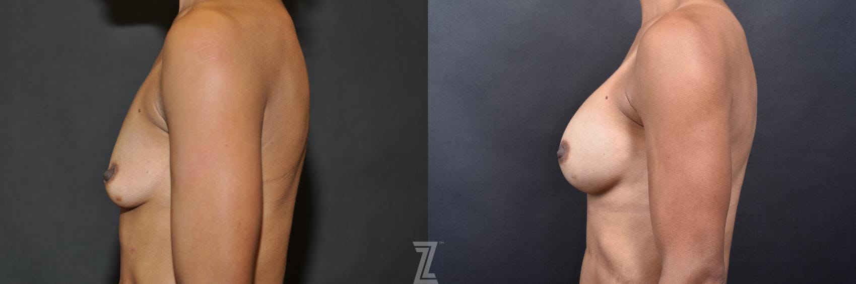 Breast Augmentation Before & After Gallery - Patient 132790659 - Image 3