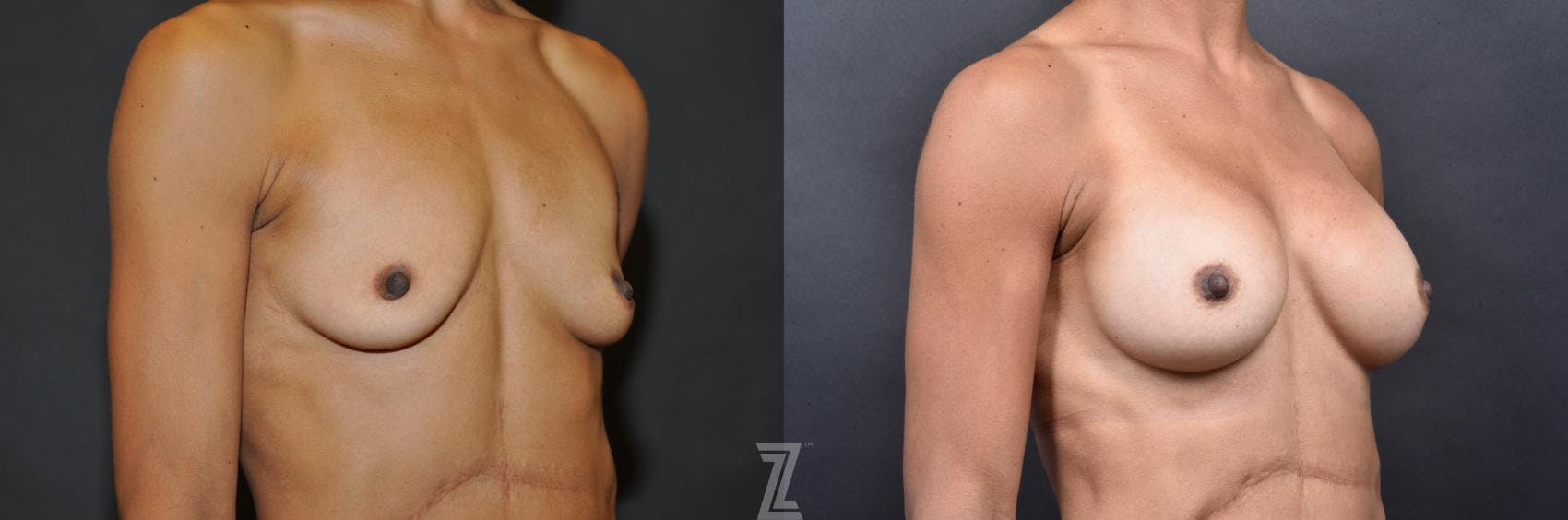 Breast Augmentation Before & After Gallery - Patient 132790659 - Image 4
